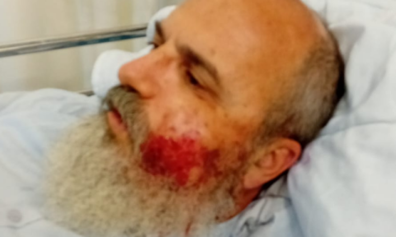 חשש לשבר בלסת [צילום: מתוך דף הפייסבוק של עמנואל שילה]