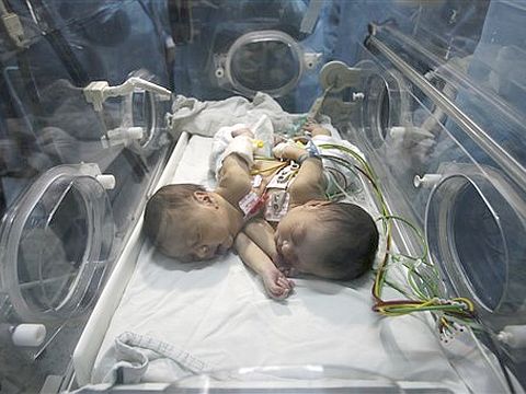 התאומות הסיאמיות בבית החולים [צילום: AP]