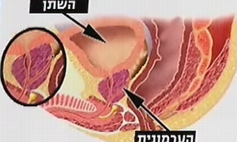 ערמונית