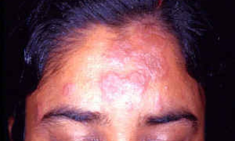 [צילום: American Academy of Dermatology]