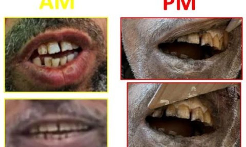 צילומי השיניים של סינוואר לפני ואחרי [צילום: דוברות המשטרה]