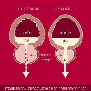 ערמונית בריאה וערמונית מוגדלת [צילום: יח"צ]
