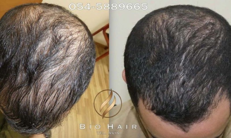 [צילום: biohair]